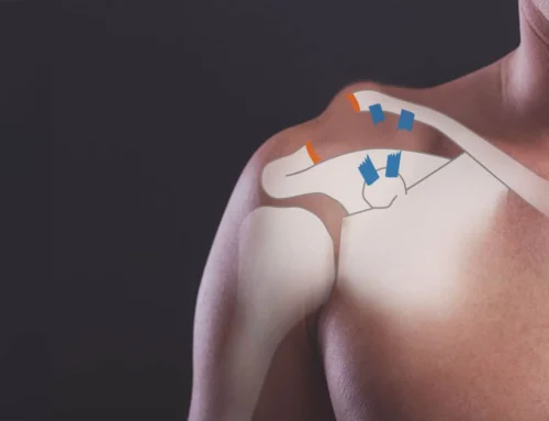 Disjonctions acromio-claviculaires