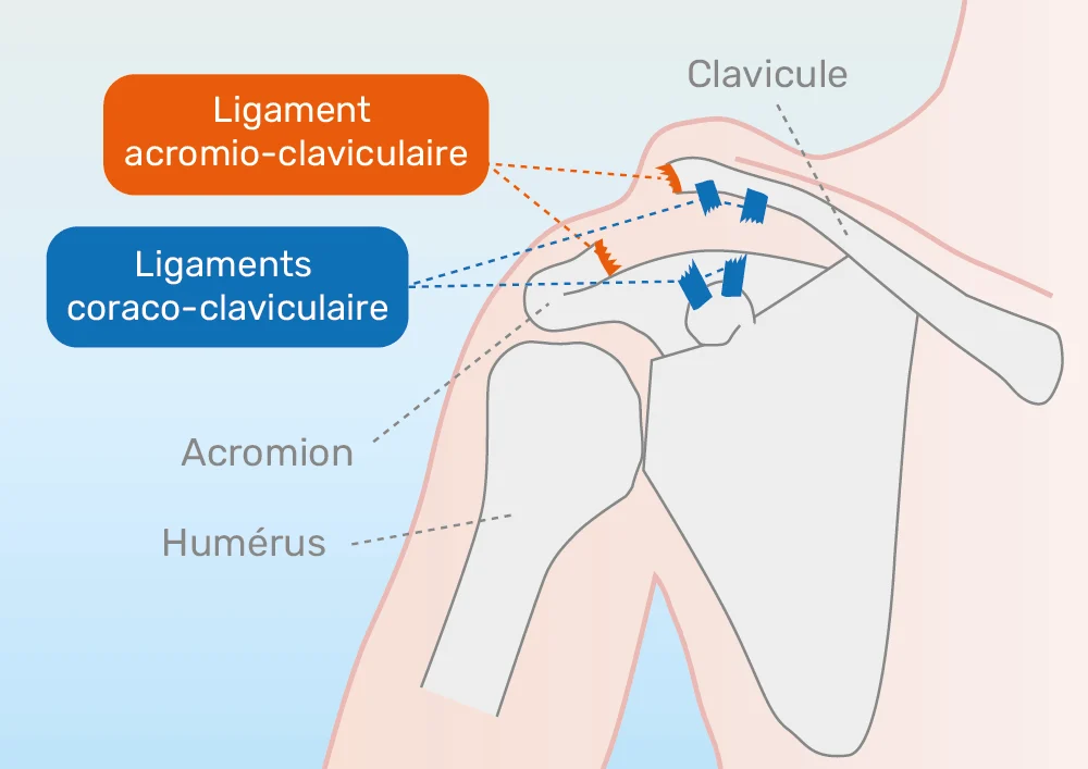 Disjonctions acromio-claviculaires