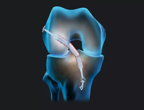 Reconstruction du ligament croisé antérieur avec le tendon quadricipital