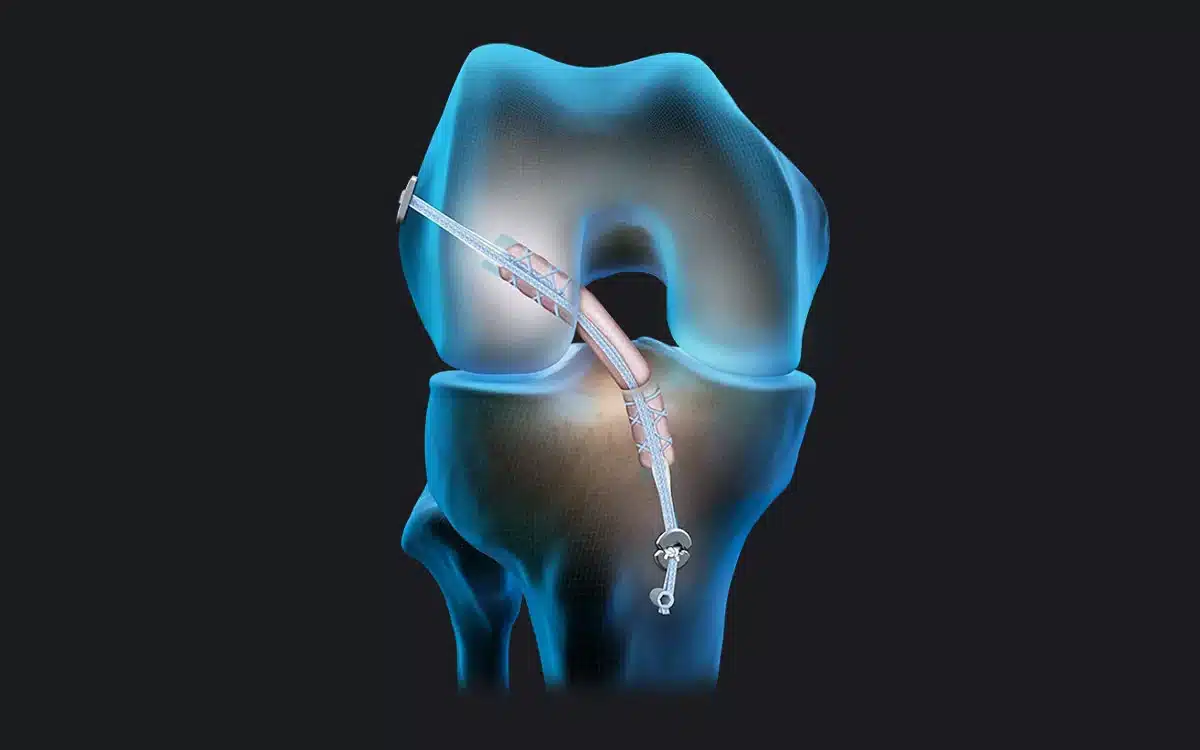Reconstruction du ligament croisé antérieur avec le tendon quadricipital