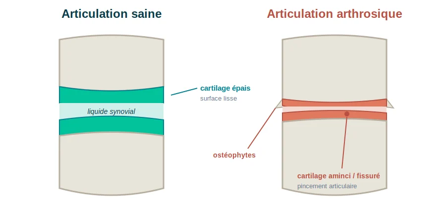 Sport et arthrose