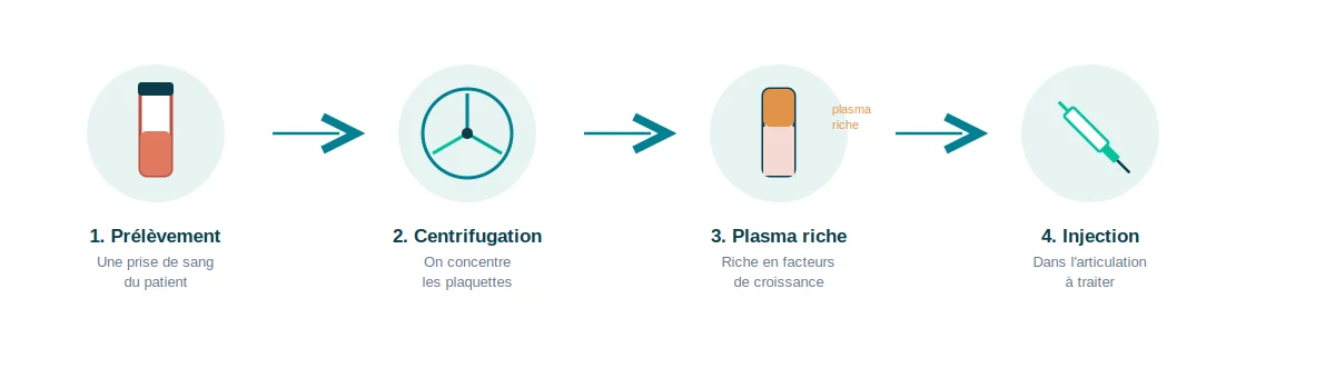 Les injections dans l’arthrose du genou